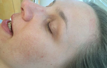 The same client after laser acne treatment, with clearer, calmer skin