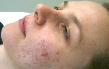 Pure Light Laser client before laser acne treatment, with active acne and redness on the cheek