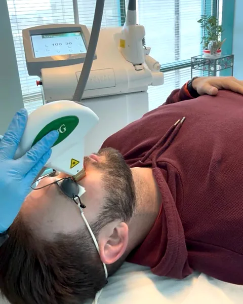IPL rosacea treatment with the MaxG handpiece at Pure Light Laser in Vancouver