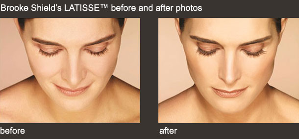 Latisse before and after