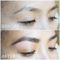 Pure Light Laser Treatment Vancouver Microblading