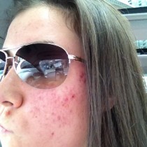 How I Cured My Adult Acne & Got Rid of Scarring