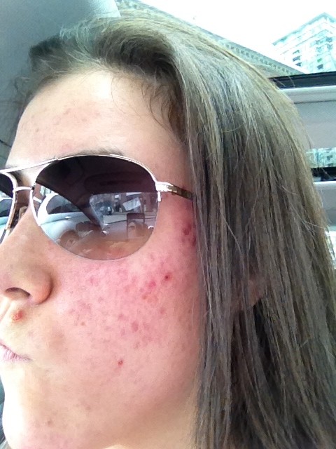 Kris's adult acne and redness before treatment at Pure Light Laser