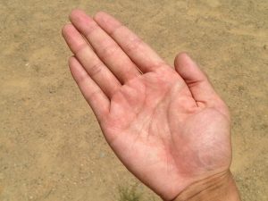 dermabrasion-hand