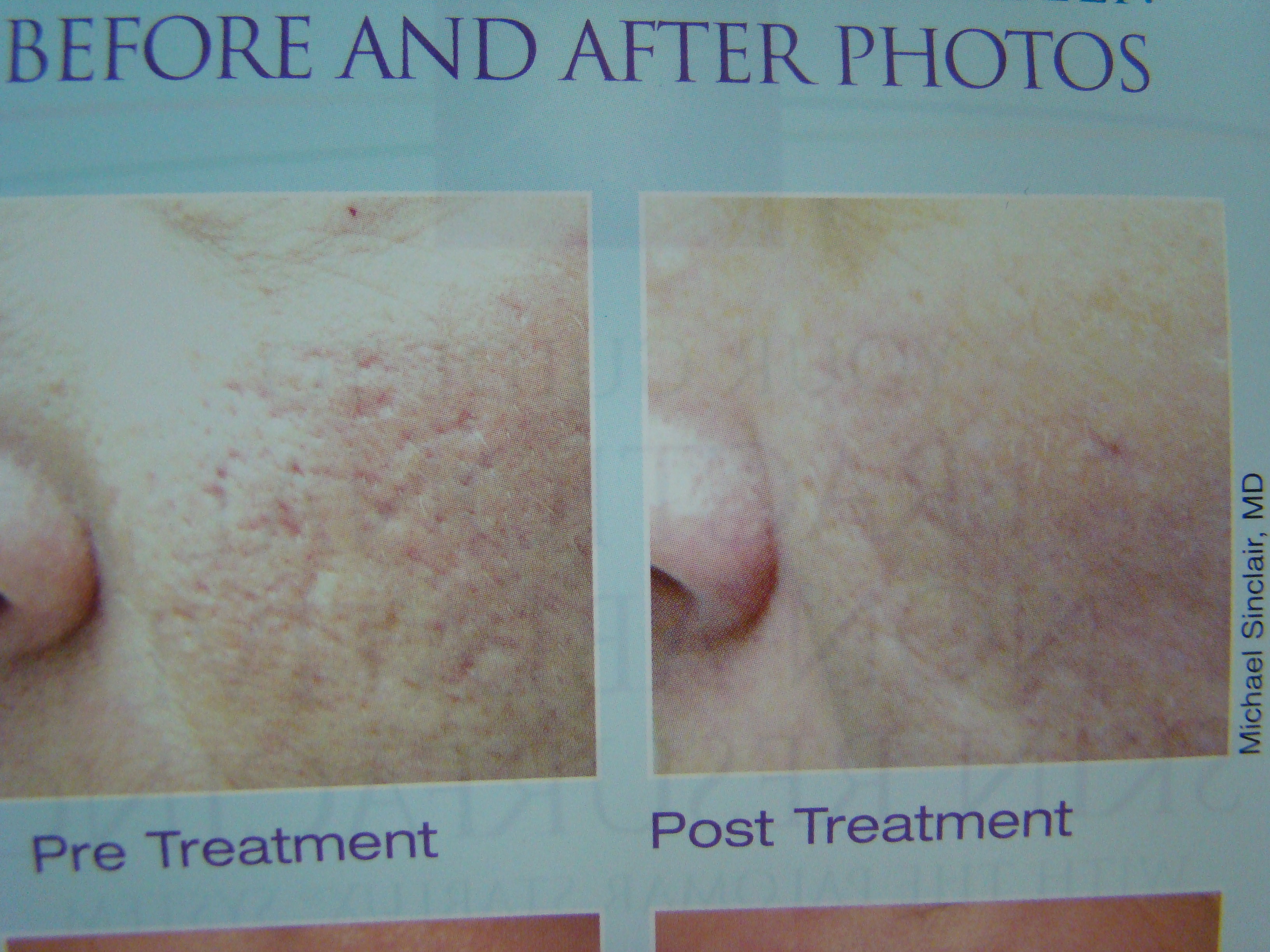 Acne scarring before and after fractional laser treatment