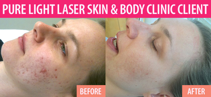 Before and after of laser acne treatments in Vancouver at Pure Light Laser