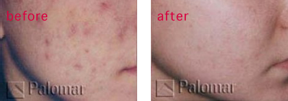 laser acne scar removal vancouver treatments before and after