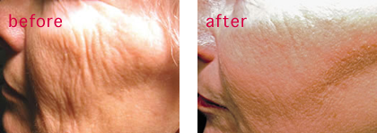 laser-resurfacing-vancouver