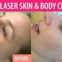 A first-hand experience with treatment for cystic acne