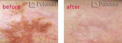 scar-revision-vancouver-before-after